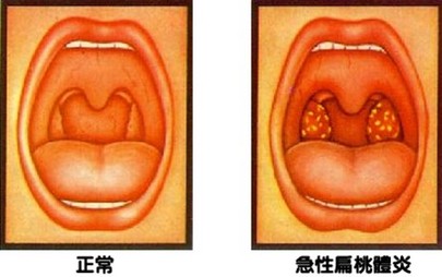 正常喉咙照片 小儿图片