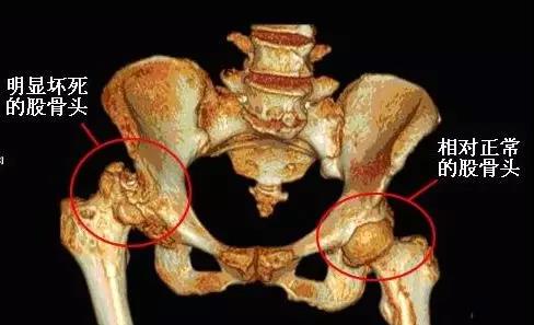 一般看來,創傷性股骨頭壞死是由於人體骨頭受到外傷,包括股骨頸骨折和